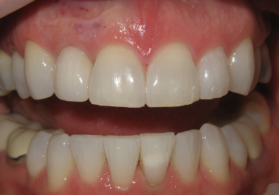 Smile Gallery - After